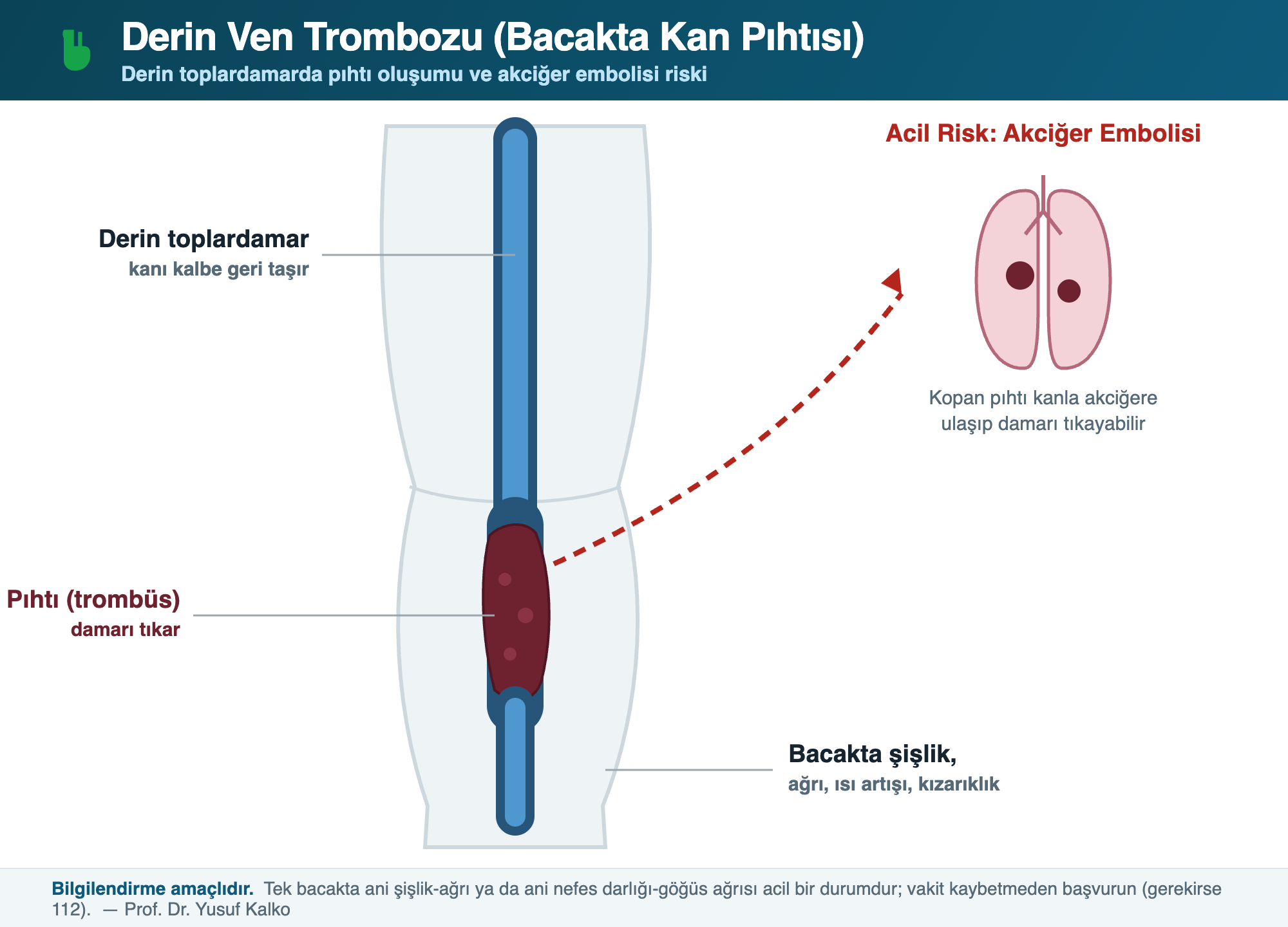 Bacakta tek taraflı şişlik ve ağrı — derin ven trombozu (pıhtı) belirtisi