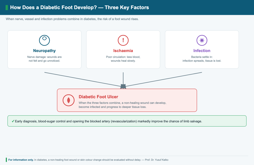 How a diabetic foot develops: neuropathy, ischemia and infection