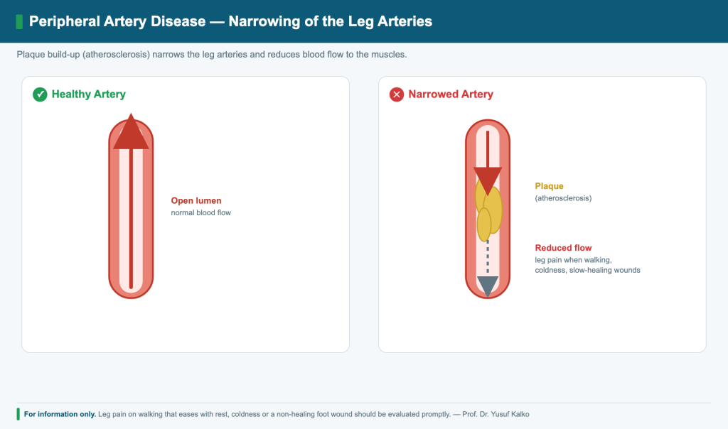 Inflammation and blockage of small arteries in the limbs