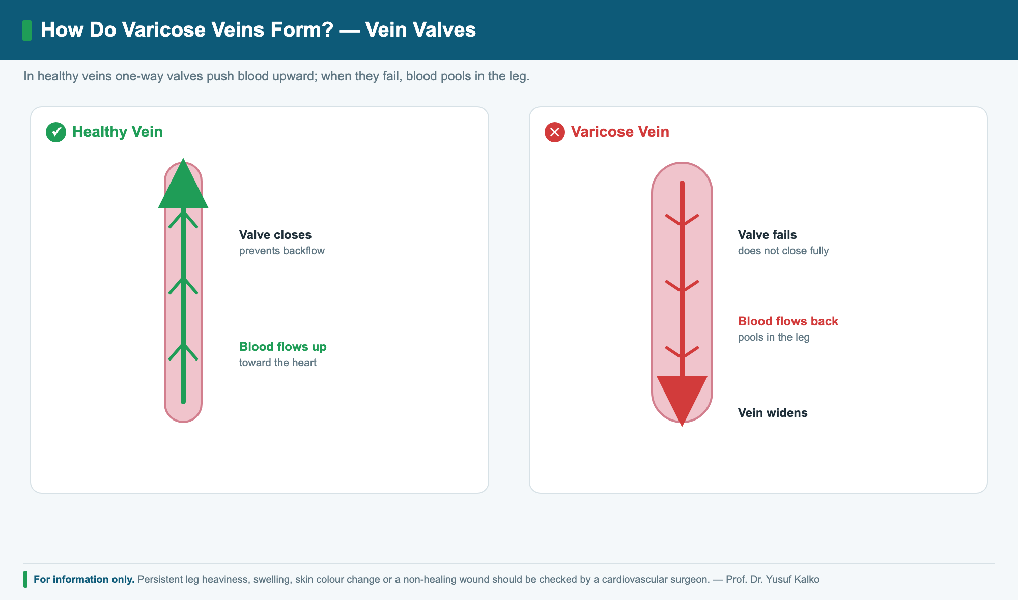 Healthy vein valve vs varicose vein with valve insufficiency