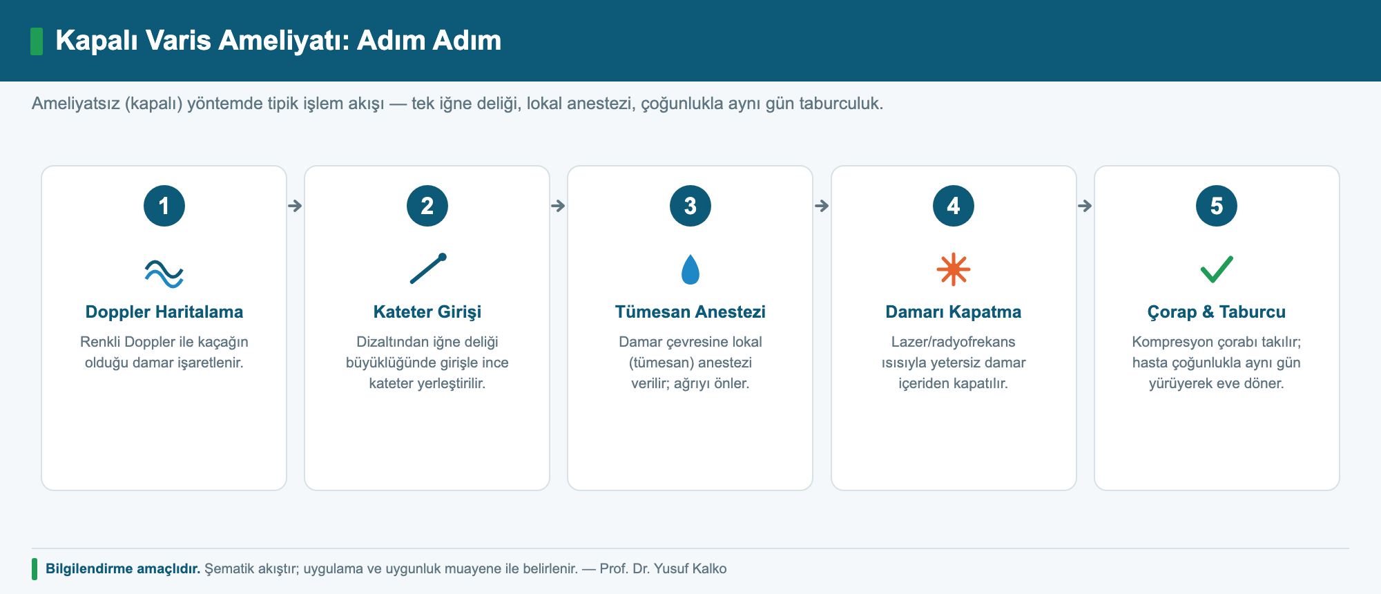 Kapalı varis ameliyatı adım adım: Doppler, kateter, tümesan anestezi, lazer/radyofrekansla kapatma, varis çorabı