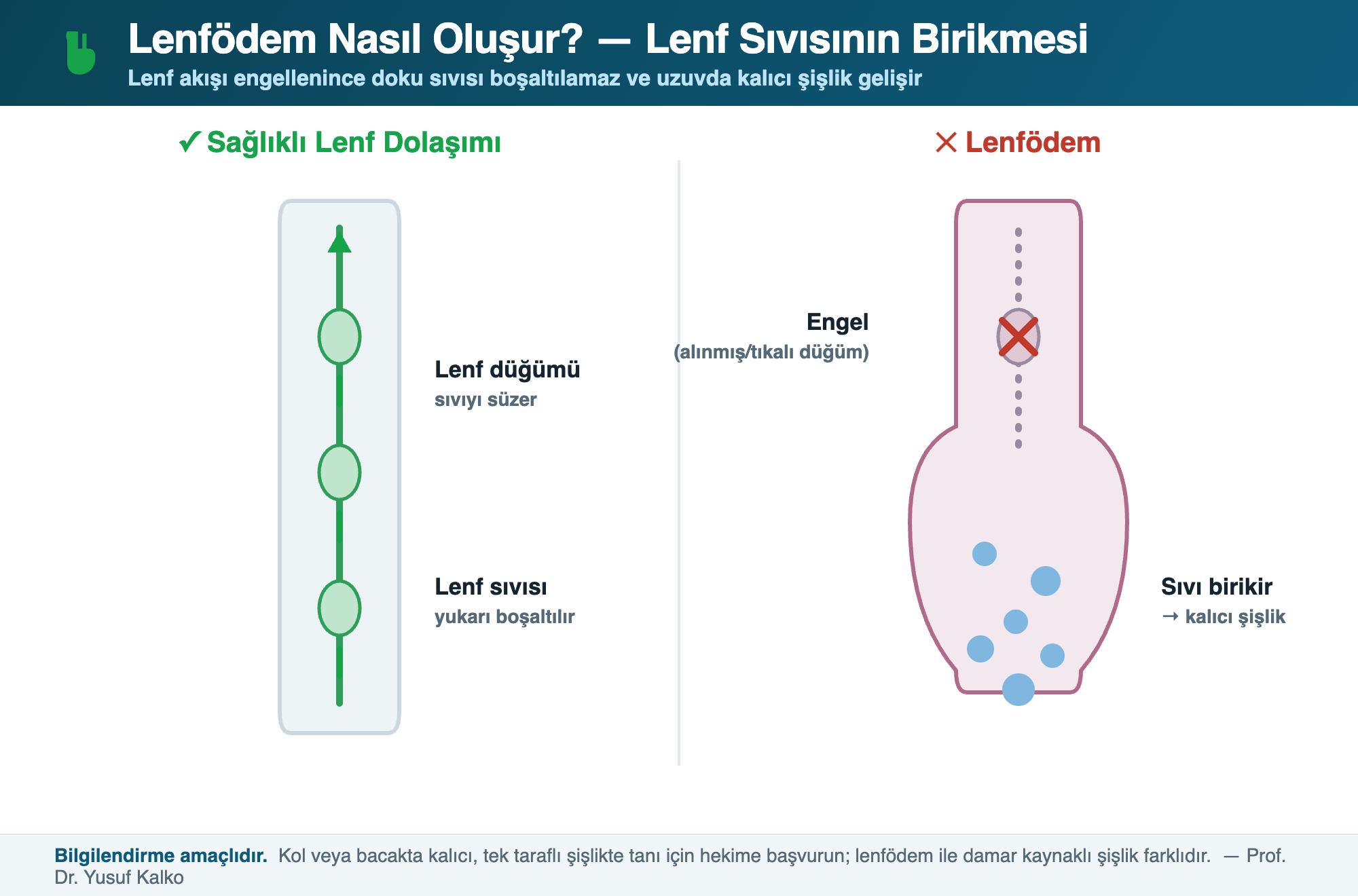 Lenfödem nasıl oluşur şeması: sağlıklı lenf dolaşımında sıvı yukarı boşaltılır; lenfödemde alınmış veya tıkalı lenf düğümü nedeniyle sıvı birikir ve uzuvda kalıcı şişlik gelişir