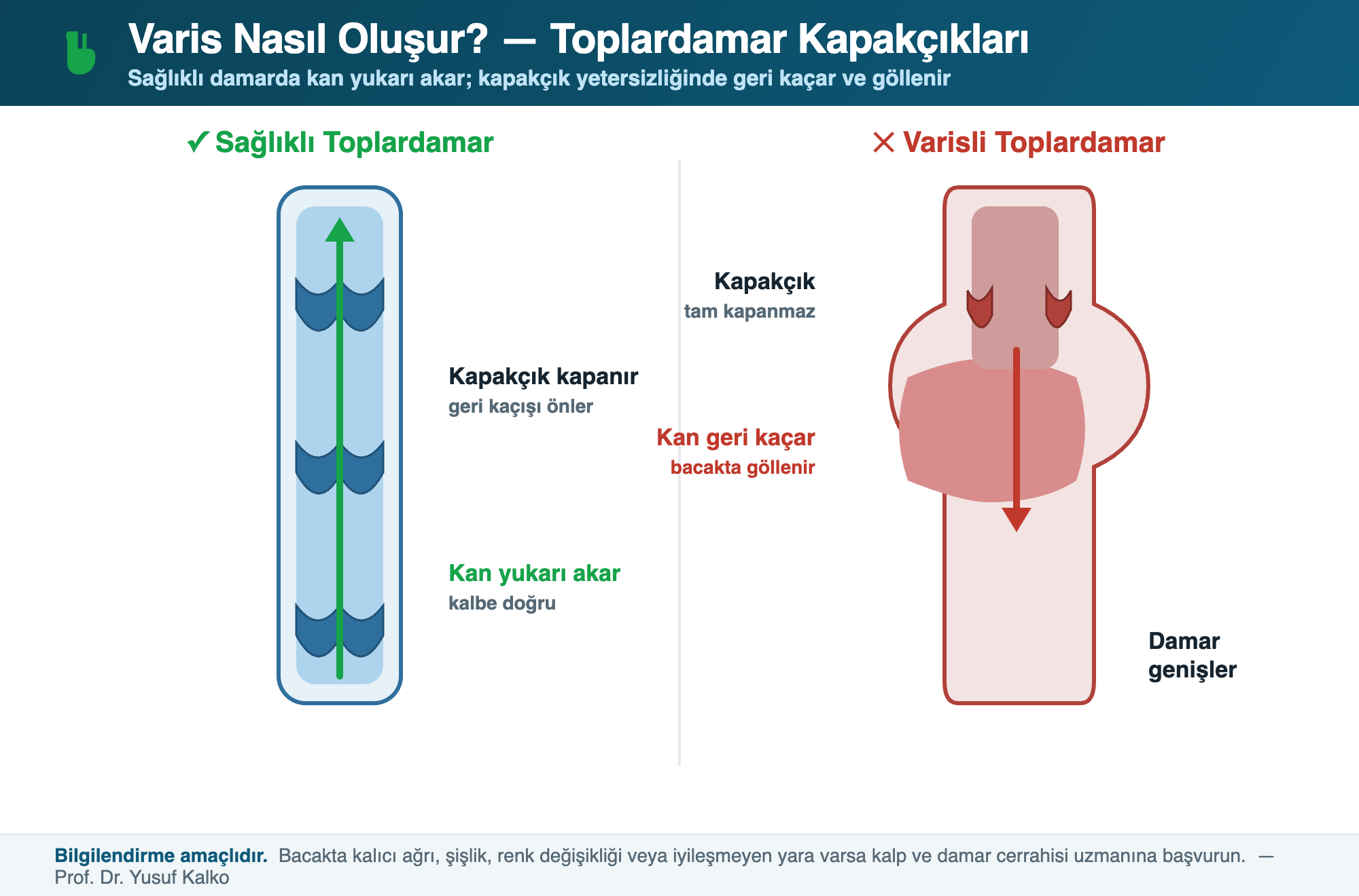 Varis oluşumu şeması — tedavi yöntemi damarın durumuna göre seçilir