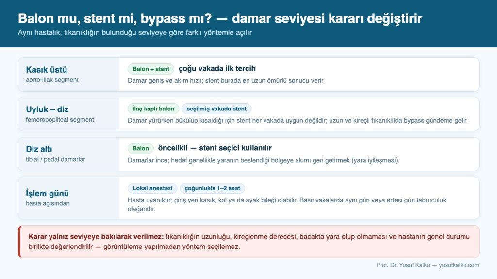 Balon mu, stent mi, bypass mı? Bacak damarında tıkanıklık seviyesine göre yöntem seçimi