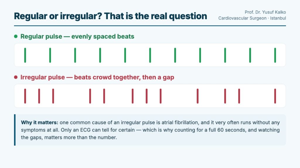 Comparison of a regular pulse with evenly spaced beats and an irregular pulse where beats crowd together then leave a gap