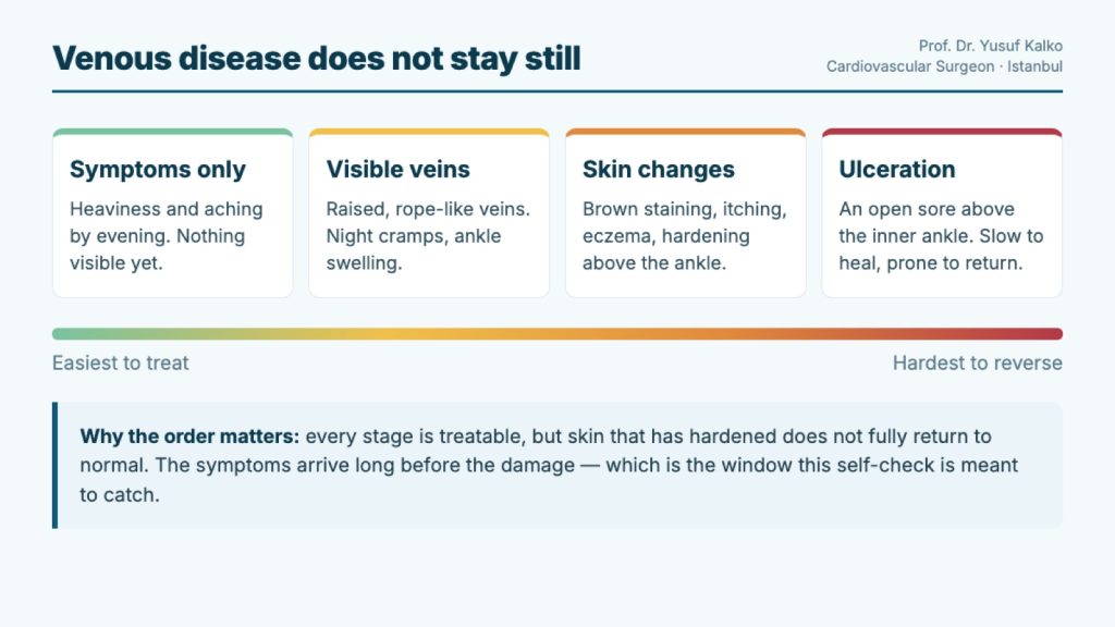Four stages of venous disease from symptoms only to ulceration